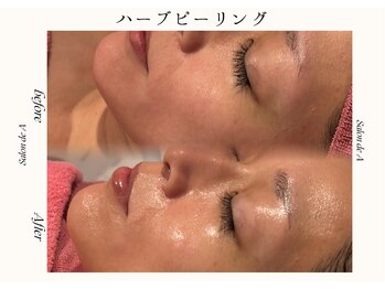 サロンドエー 帝塚山(Salon de A)/ハーブピーリング