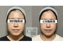 キュープ 表参道店(Qpu)/美顔器モニターコース4回の変化