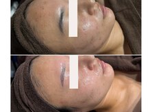 フェイスプラスリフ(FACE+RiF)/ニキビ、肌荒れ、毛穴、くすみ