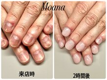 モアナ 池袋(MOANA)/人工爪深爪