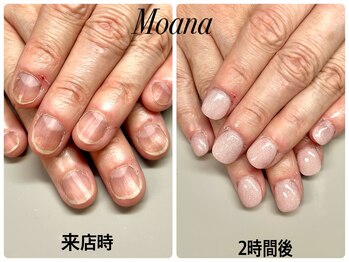 モアナ 池袋(MOANA)/人工爪深爪