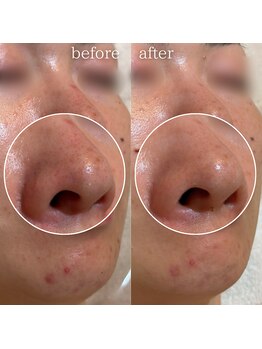 エステティックサロン ナチュラーレ/毛穴・色ムラ・ニキビ