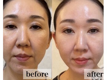 ヴィディトゥ(vidyto)の写真/韓国艶肌整◯級！圧倒的肌変化【インセルダム】毛穴/たるみ/シワ/しみ/くすみエイジングケアが叶う