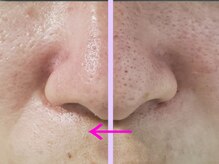 マニル アンド ネトラ(manil & netola)/毛穴大掃除！