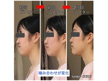 ノリスズ(NORI SUZU)の雰囲気（顎関節、エラ張りも改善。下あご・口元ライン・鼻の形も変化☆）