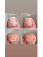 ミシュリーヌ(micheline.)/お悩み爪、巻きの補正症例