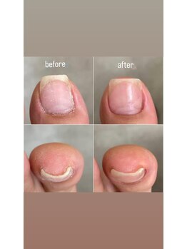 ミシュリーヌ(micheline.)/お悩み爪、巻きの補正症例