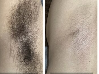 ケイ(Kei)/男性☆脇脱毛before /after 