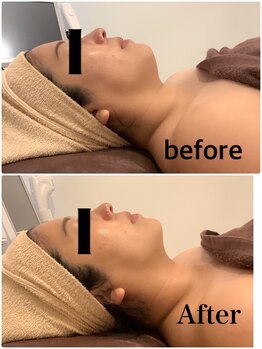 スペチアーレ 夙川/炭酸ピーリングでつるつる肌に