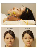 芦屋楓鍼灸院/小顔効果実績に自信あり★