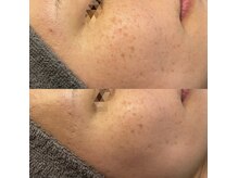 モルセラ(Moluccella)/5回の施術