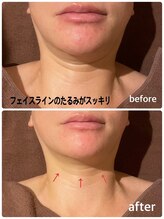 ビンナ(BINNA)/ビフォーアフター　レモンボトル