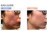 限定価格【ニキビケア、ほうれい線・毛穴ケア共通5回コース】完璧美肌を作る
