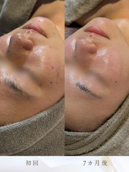 ベルーチェ(Beluce)の写真/お肌悩みを繰り返してしまう理由をどこより徹底分析。ニキビ/毛穴ケア[REVI/プラズマニア/クリスティーナ]