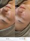 ベルーチェ(Beluce)の写真/お肌悩みを繰り返してしまう理由をどこより徹底分析。ニキビ/毛穴ケア[REVI/プラズマニア/クリスティーナ]