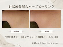 プライベートエステサロン トゥインクル/左右で出やすさに違いのある方も