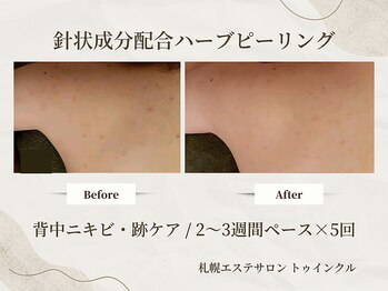 プライベートエステサロン トゥインクル/左右で出やすさに違いのある方も