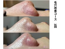 ボニータ(Bonita)/毛穴エクストラクション