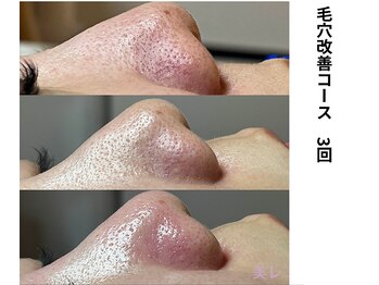 ボニータ(Bonita)/毛穴エクストラクション