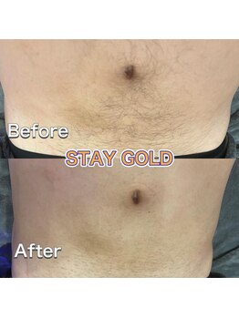 ステイゴールド 新百合ヶ丘(STAY GOLD)/お腹周りからギャランドゥー脱毛