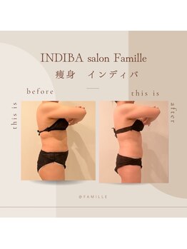 ファミーユ 新宿店/【インディバ お腹ケア】