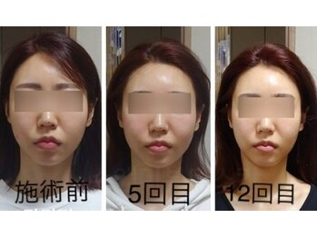 ケイビューティーサロン(K BeautySalon)/痛いって聞くけど、実際はどう？