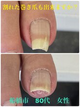 巻き爪じゅん 千葉駅前店/どんな巻き爪でもお任せください