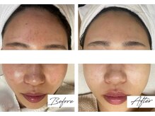 ビズビズ 梅田店(bisebise)/ニキビケア/ハイドラ毛穴洗浄