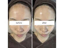 リボン(Ribbon)/延髄スプレーラグジュアリー