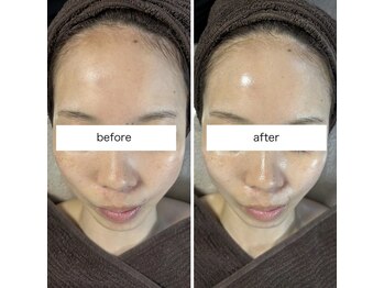 リボン(Ribbon)/延髄スプレーラグジュアリー