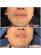 カナウ(KANAU) 人気No.1 ヒゲ脱毛