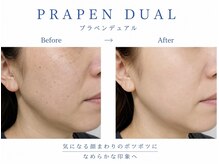 ムーン 高崎店(MOON)/プラペン！気になる肌のポツポツ