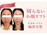【人気No.1】切らない小顔リフト◎たるみ・ほうれい線・頬コケをまとめてケア