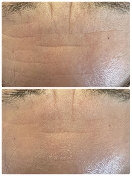 サロン ド カリナン(salon de Cullinan)/プラズマでおでこしわケア!!!