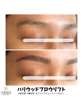 アクシア ビューティー サロン(AXSIA)/【HBL】BeforeAfter