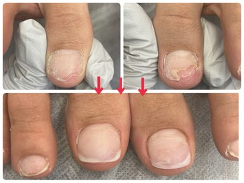 爪処 中野坂上/トラブル爪