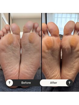 マオヌー(MAONU)/韓国式足裏角質ケア　症例写真