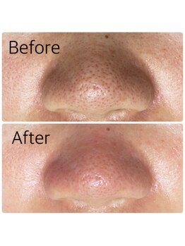 エミリー 守山(EMILY)/【症例写真】毛穴洗浄 (1)