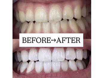 ホワイトニングサロン 宝塚/Before&After美白ホワイトニング