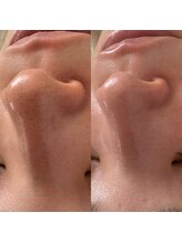 モア 吉祥寺(MORE.)/毛穴洗浄Before after