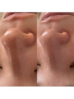 モア 吉祥寺(MORE.)/毛穴洗浄Before after