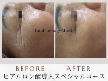 トータルビューティー マインド(Total Beauty)/《ヒアルロン酸導入セラピー》