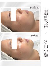 リアム(LiAm)/ララピール×レモンボトル