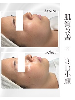 リアム(LiAm)/ララピール×レモンボトル