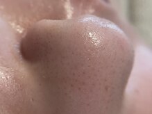 リセットプラス(Reset+)/お鼻の産毛目立っていませんか？