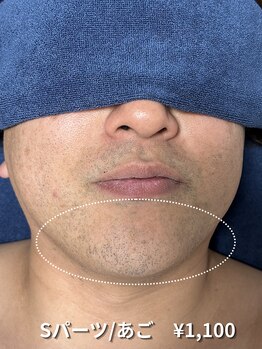 カナウ(KANAU)/【Sパーツ/脱毛】あご