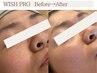 【人気NO.1】毛穴の黒ずみ・開きに特化！敏感肌・ごわつき肌もつるんと陶器肌