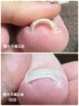 特許出願！【巻き爪補正】お悩み解決！¥3300～