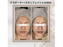 新メニュー♪最新小顔マシン《テラボーラー》とWAXの最強艶肌