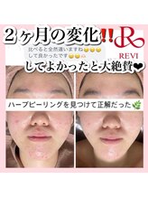 ホワイトアクア 新宿本店(WHITE AQUA)/ハーブピーリング/東京/新宿